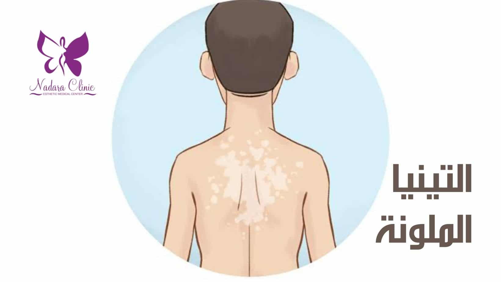 التينيا الملونة